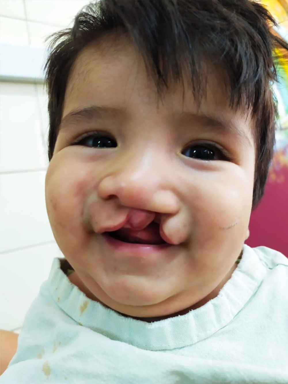 Felix before his free Smile Train-sponsored cleft surgery in Argentina