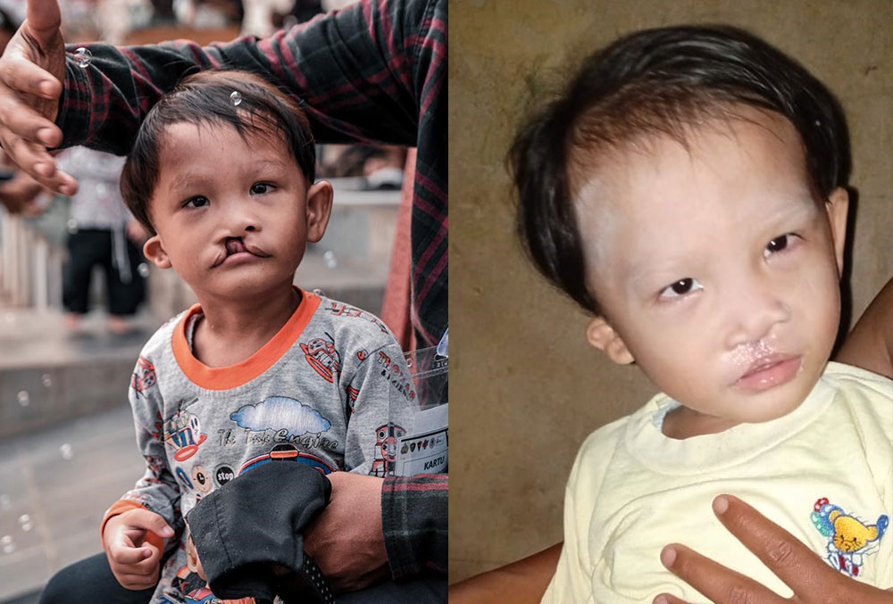 A child before and after free Smile Train cleft surgery in Indonesia
