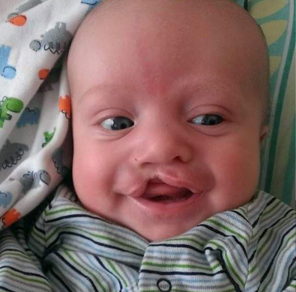 Daniel as a baby before cleft treatment