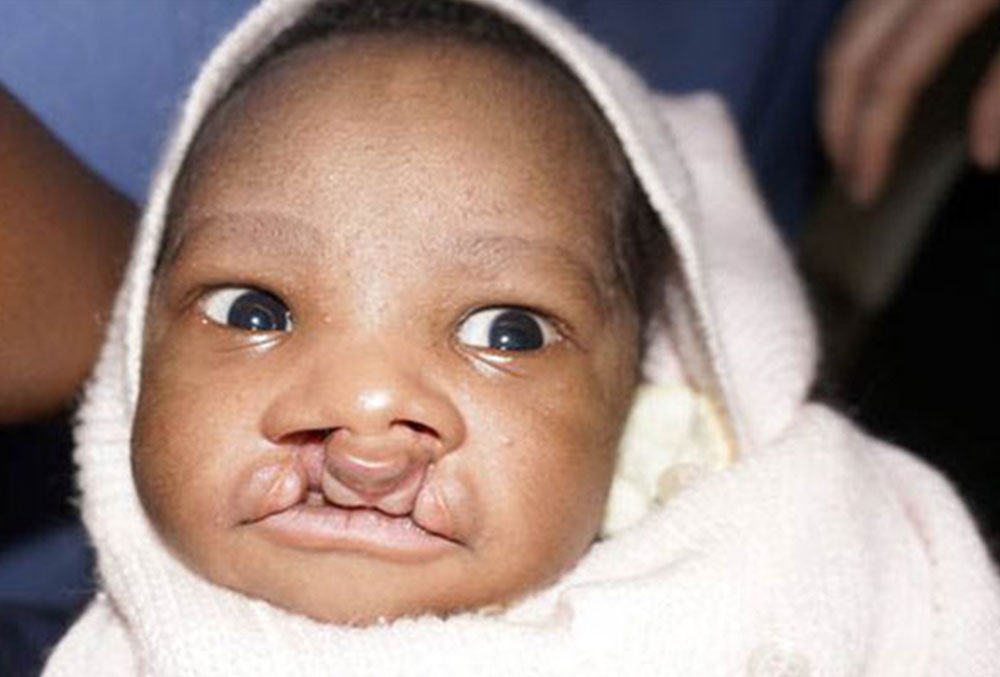 Livingstone before cleft lip and cleft palate surgery