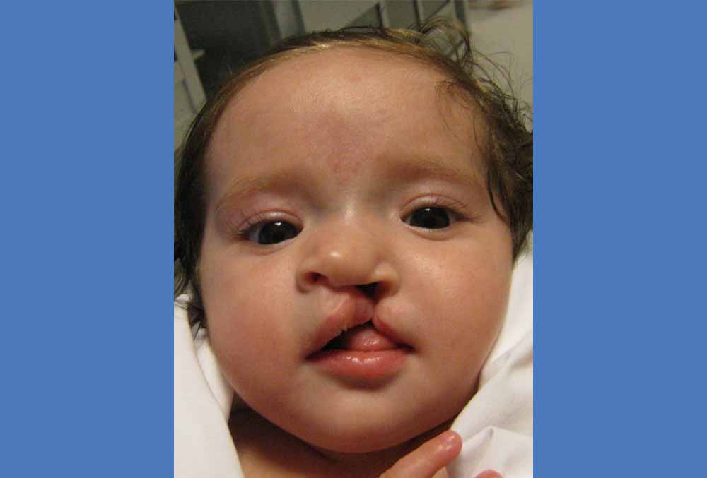 Mia before cleft surgery