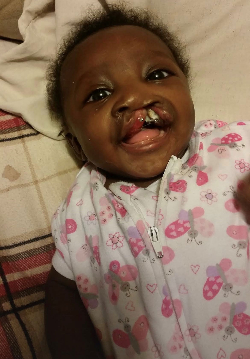 Norah before cleft surgery