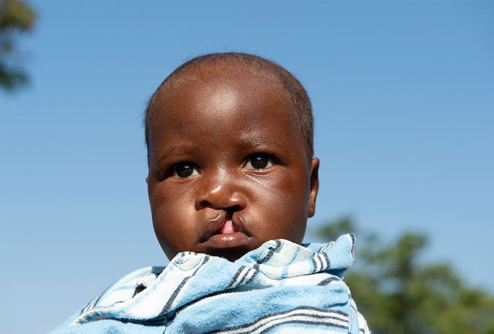 Nyasha before his free Smile Train-sponsored cleft surgery