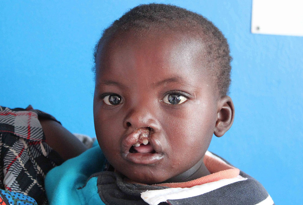 Oscar before free cleft lip and palate surgery in Zambia.