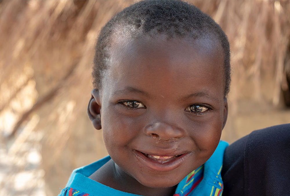 Close-up of Oscar's face and brilliant smile following his free cleft lip and palate treatment sponsored by Smile Train in Zambia.