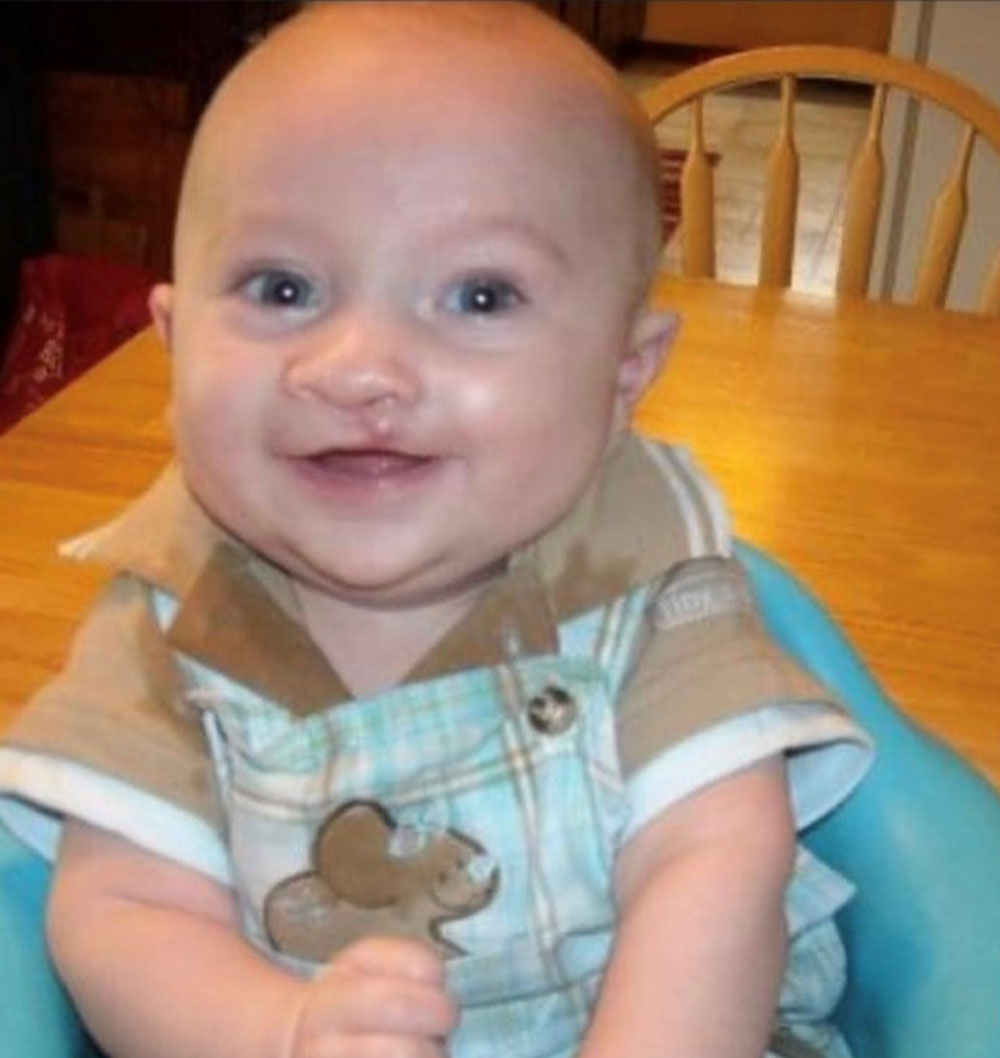 Presley after his cleft surgery