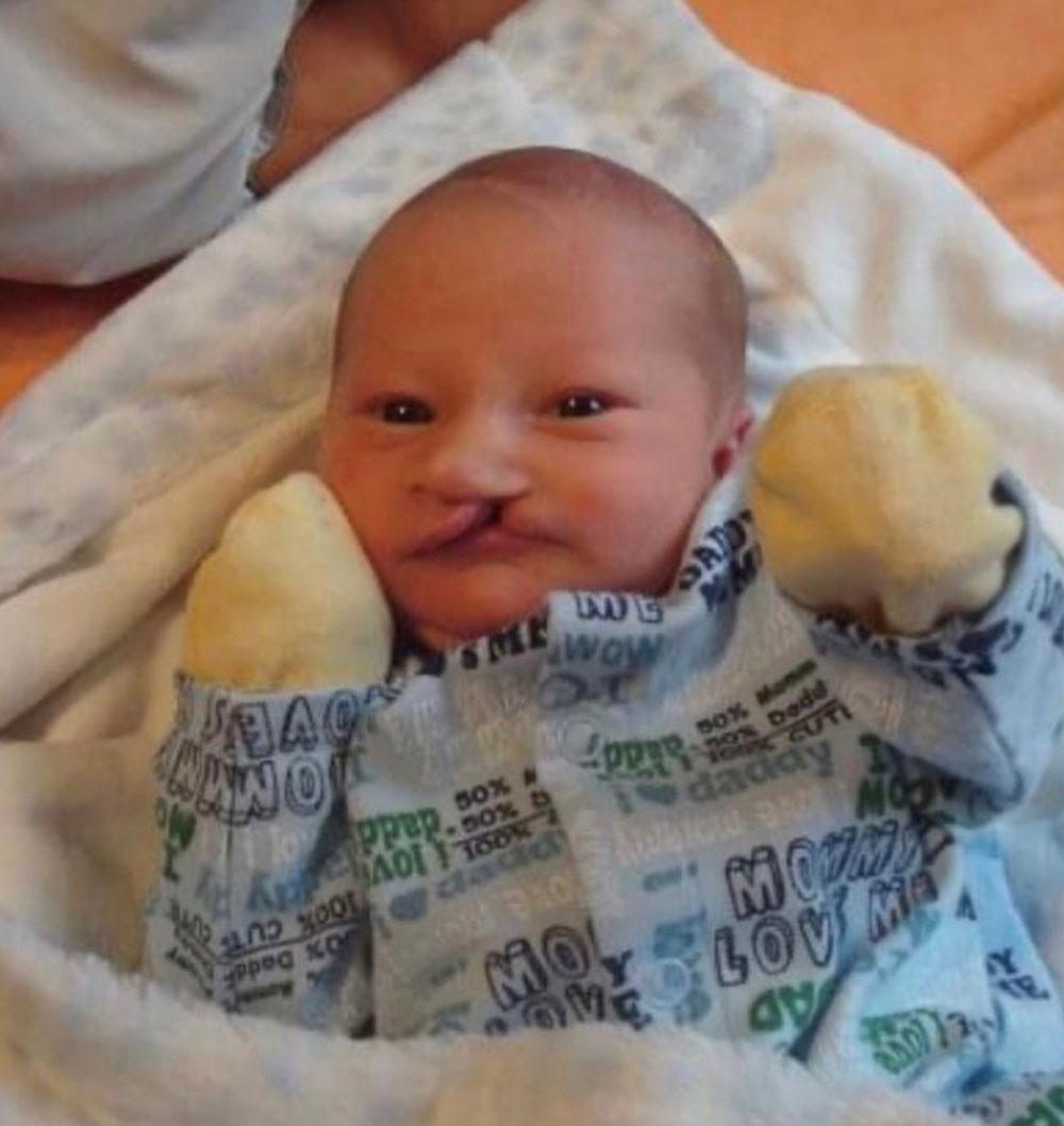 Presley with his cleft