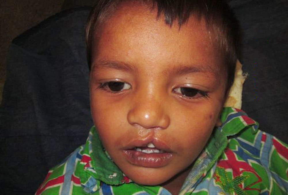 Rajesh before cleft treatment