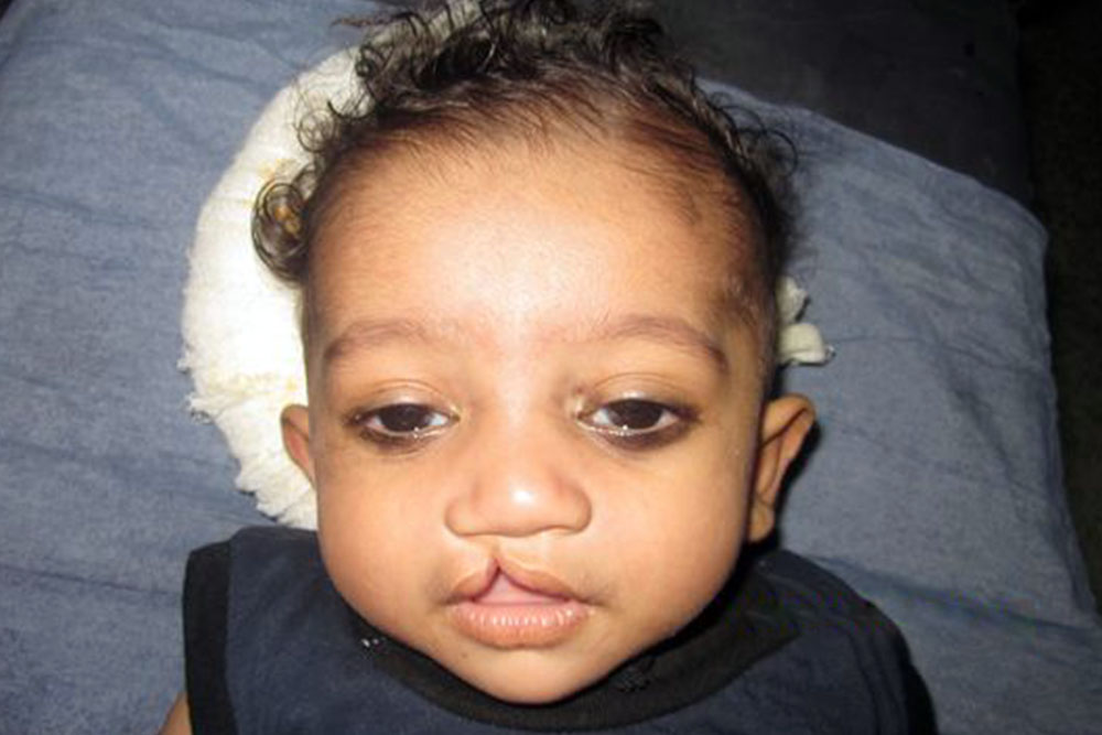 Saksham before cleft surgery