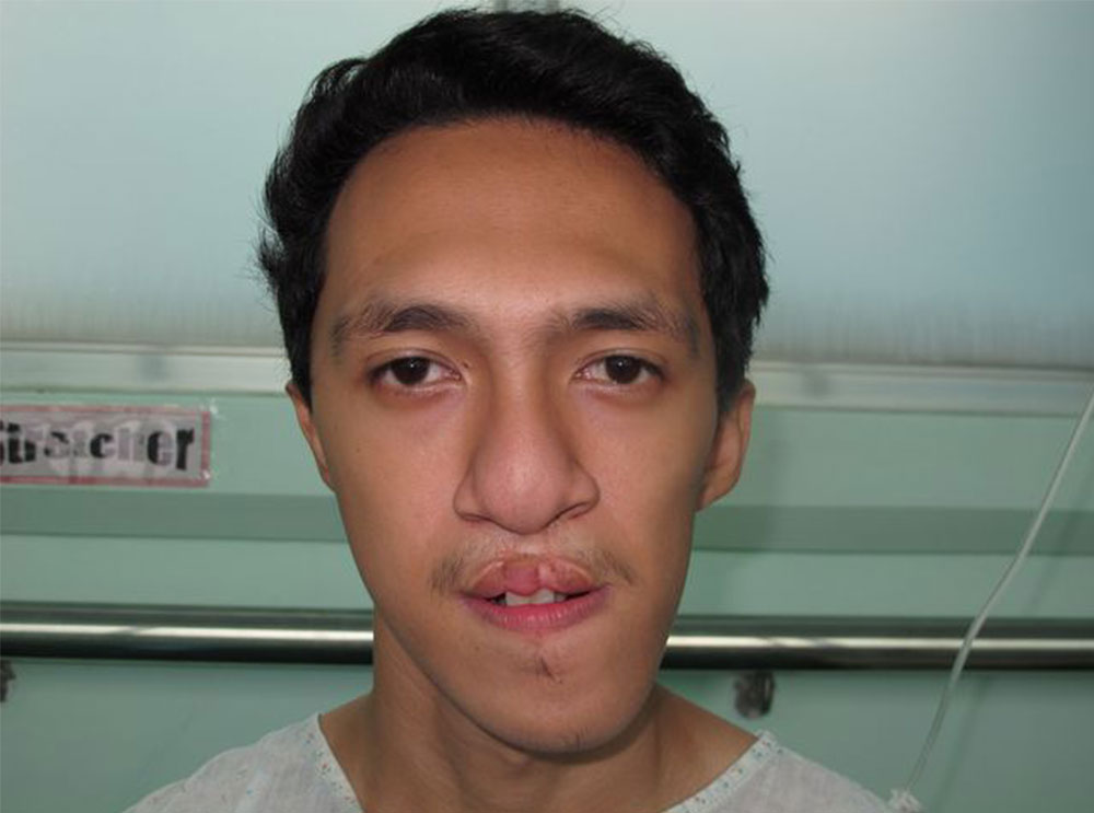 Santi in hospital receiving free Smile Train cleft surgery