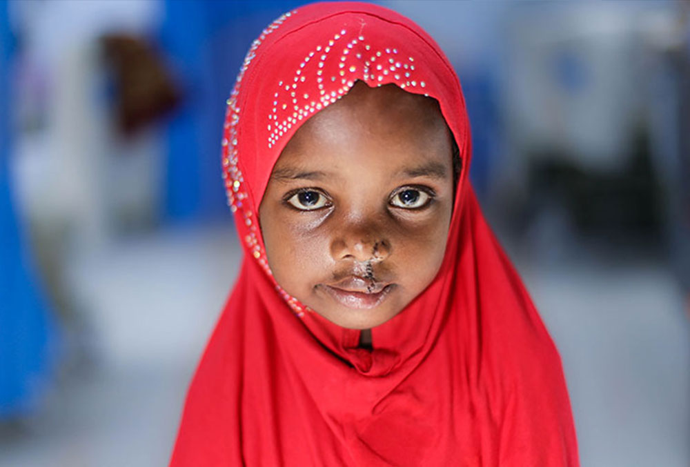 Sesnie with Kaafiyo, a girl with a cleft lip and cleft palate from Somalia.