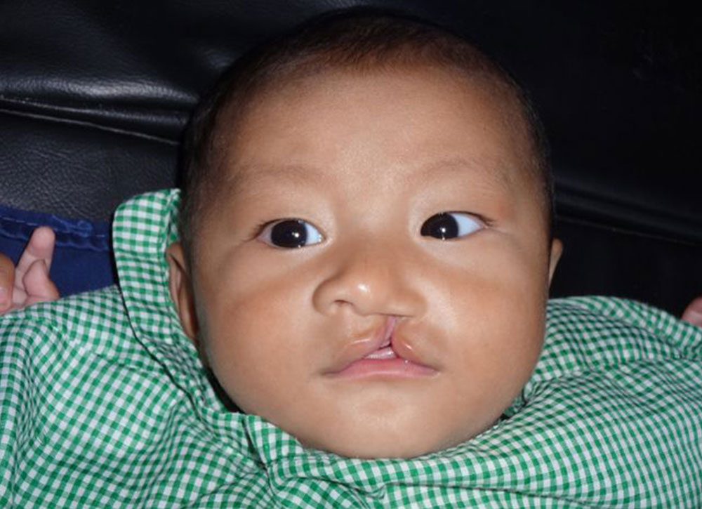 Smile before his free Smile Train cleft surgery in Nepal