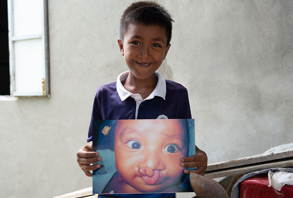 Sokim holds a picture of himself before cleft surgery