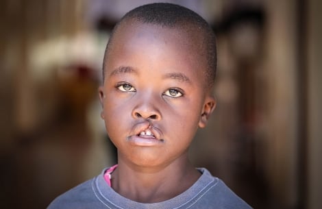 a boy from Kenya with untreated cleft