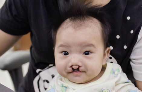 Elizabeth before cleft treatment