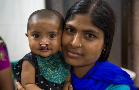 child with a cleft next to mother