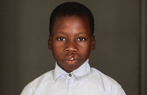 Nkunda before cleft surgery