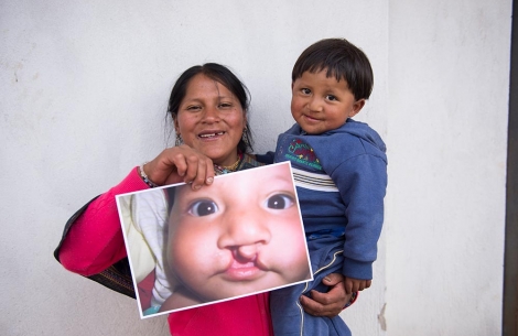 David's mom holds an image her son before cleft surgery