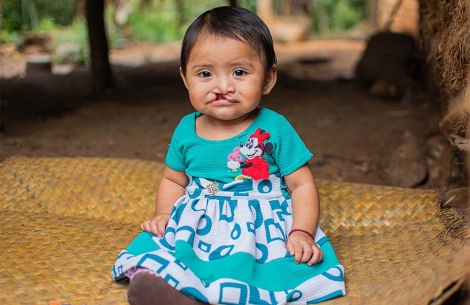 Mirian sits in a dress with untreated cleft lip