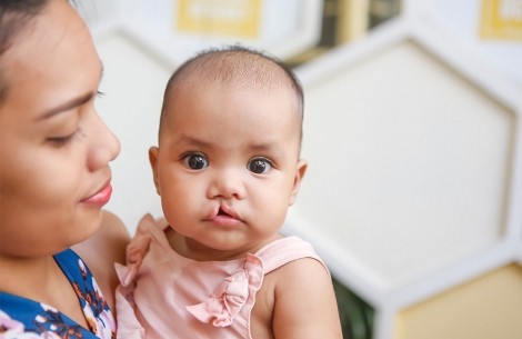 child before cleft surgery