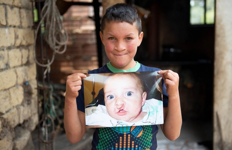 Neitan holding an image of himself before cleft lip surgery