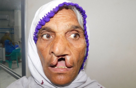 Pyari waits 70 years for cleft surgery
