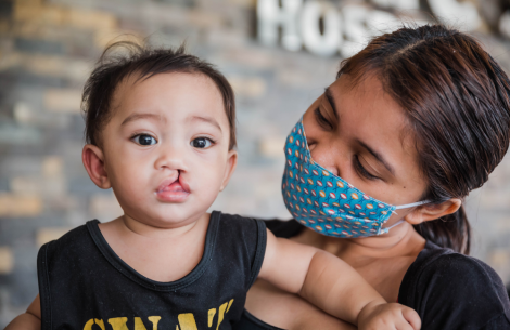 A child with an untreated cleft lip in Philippines