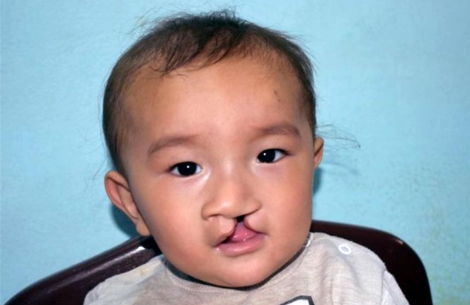 Afghani child before cleft surgery