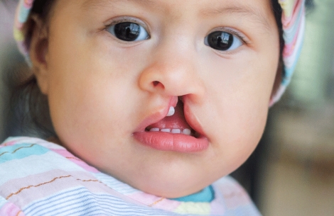 child with cleft