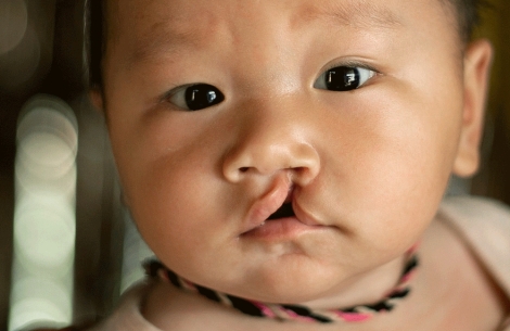 baby with cleft