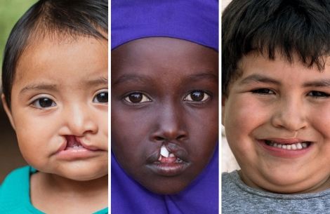 three children with cleft