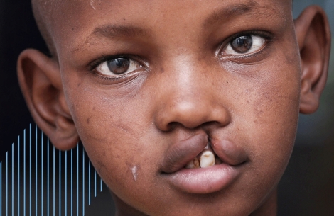 child with cleft