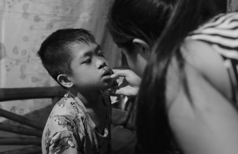 Jessa inspecting Jary’s sutured wound after his cleft surgery