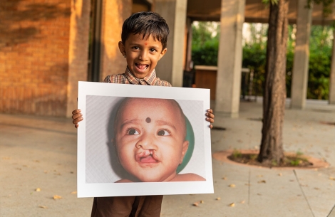 Manthan before and after surgery for his cleft