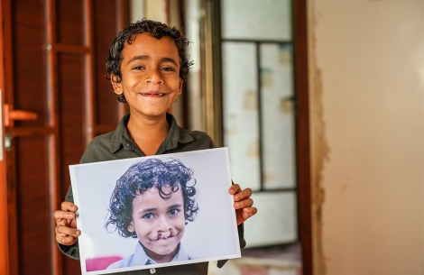 Bilal smiling, holding a picture of himself from before cleft surgery