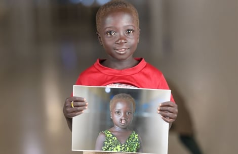 Nyanchiek smiling and holding a picture of herself before cleft surgery