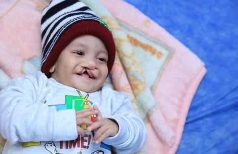 Noah laying on a blanket, smiling before cleft surgery