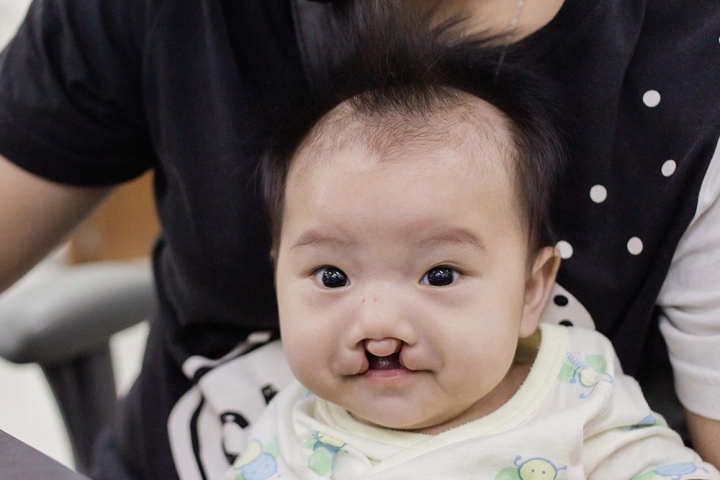 Elizabeth before cleft treatment