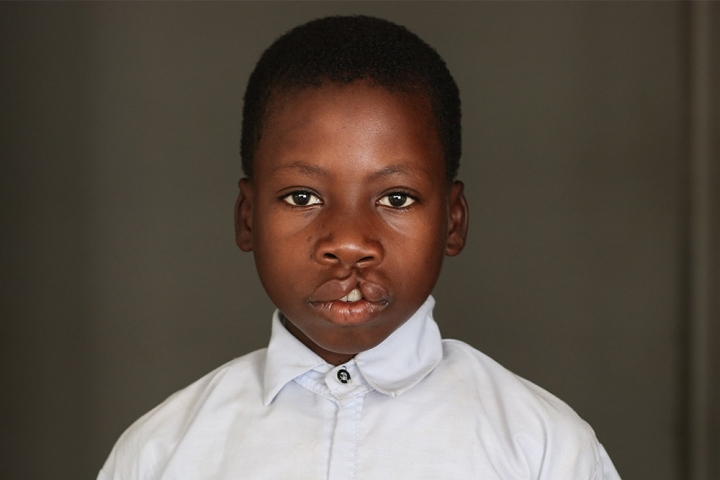 Nkunda before cleft surgery