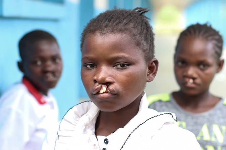 three children with cleft in DRC