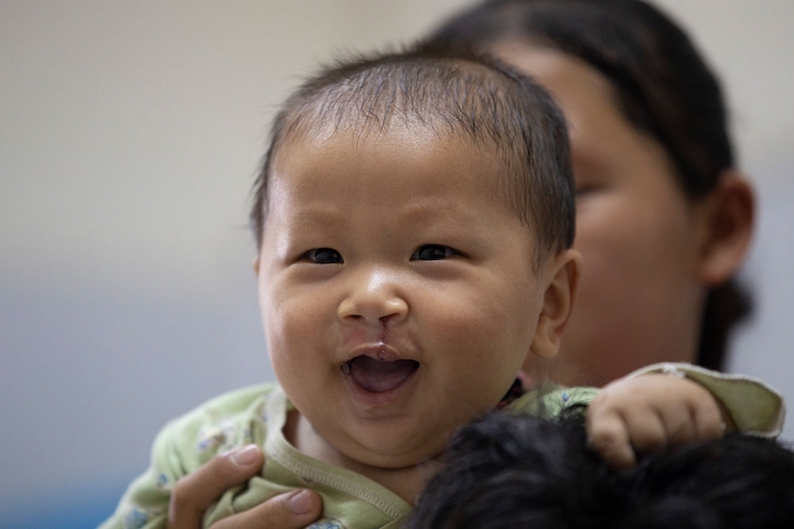 child right after cleft surgery