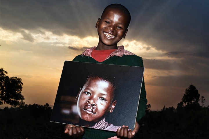 boy holding his before cleft surgery image