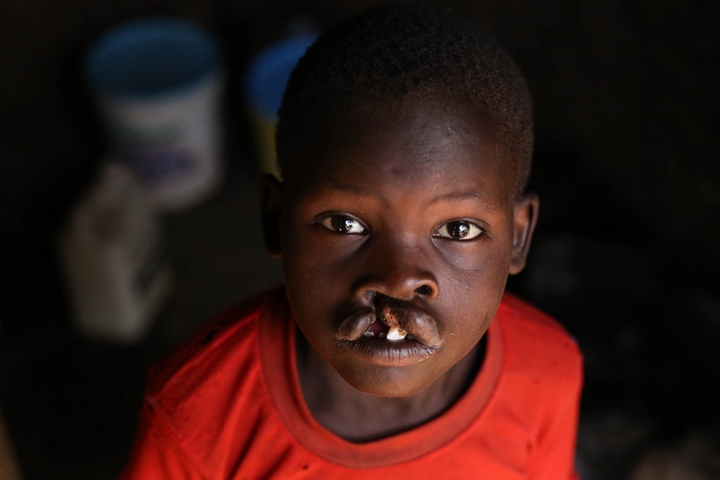 Kamse living with an untreated cleft lip in Kenya