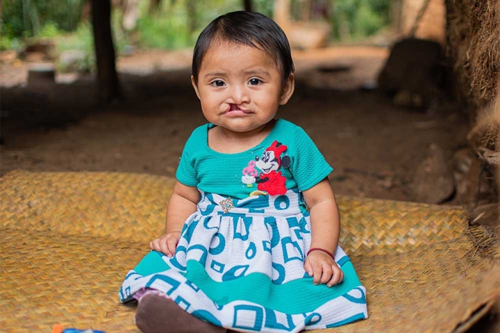 Mirian sits in a dress with untreated cleft lip