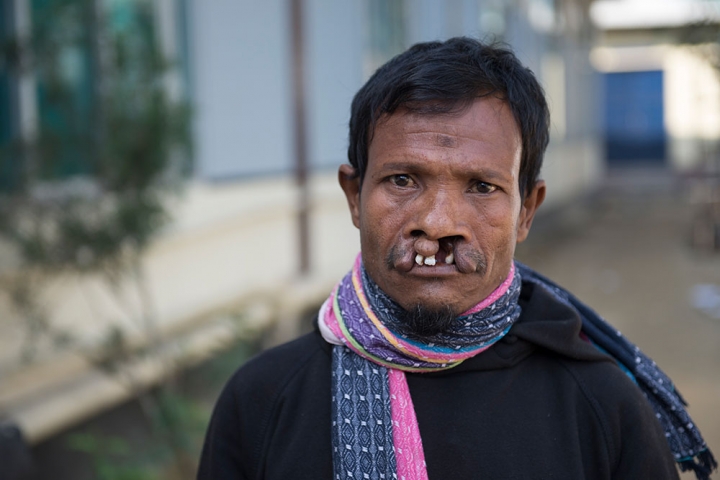 Mohammad at refugee camp living with an untreated cleft lip