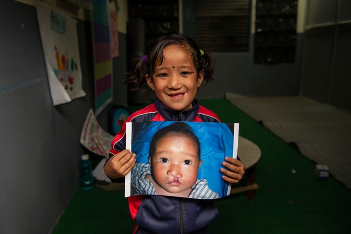 Sushila holds the image of herself before cleft surgery