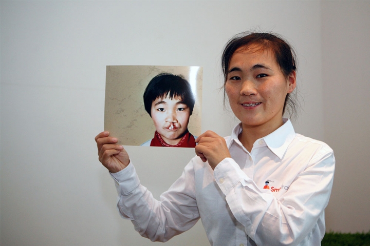 Wang Li, Smile Train's first patient, holds her before cleft surgery image