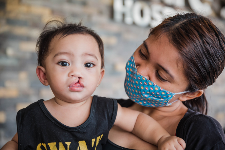 A child with an untreated cleft lip in Philippines