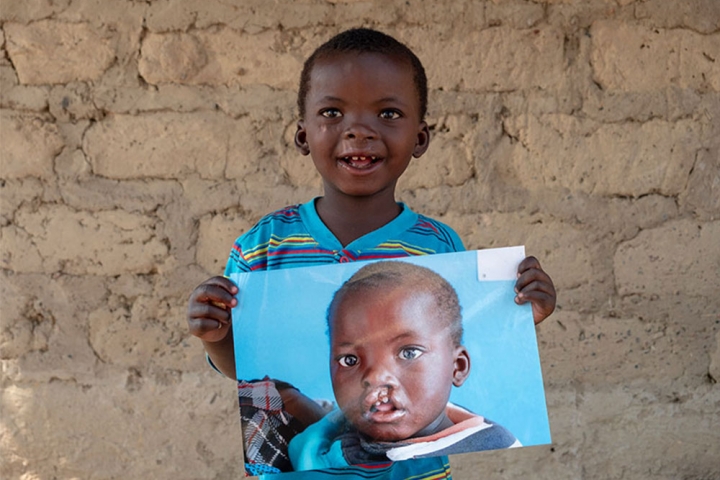Oscar holding a picture of himself before free Smile Train cleft lip and plate surgery in Zambia.