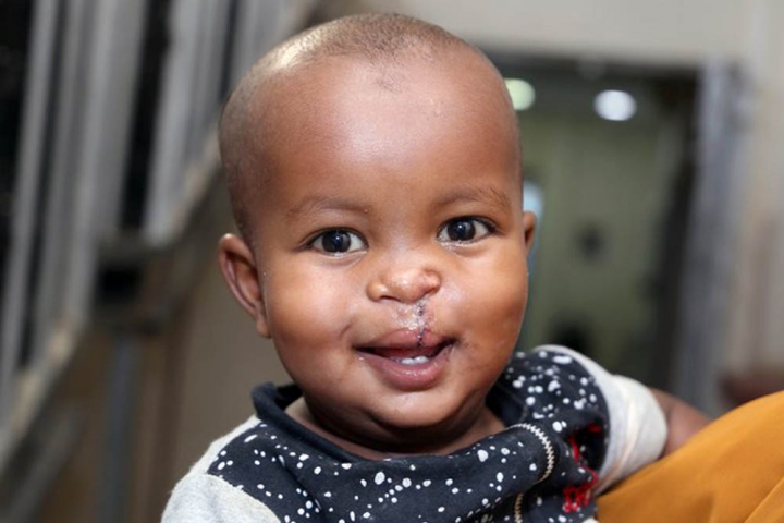 child with a cleft lip